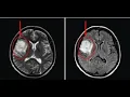 Brain Tumor Detection using Matlab - Image Processing GUI step by step
