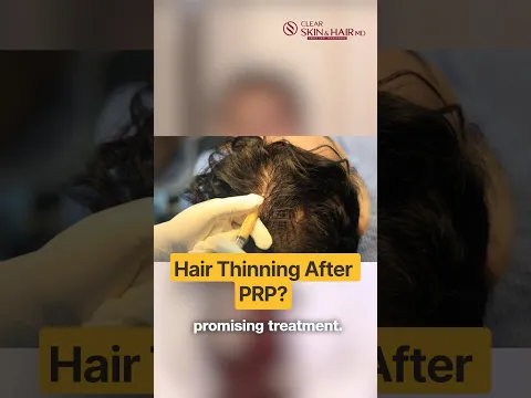 Hair Thinning After PRP? Is SVF Treatment the Next Option? | HairMD Clinic, Pune