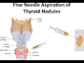 Biopsy Needle CPT code - simplify medical coding