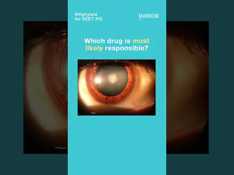 A 34-year-old woman on antipsychotics, presents with diminished vision & the given ocular finding.