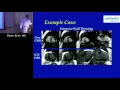 Download Lagu CMR Assessment of Myocardial Fibrosis (Dipan Shah, MD)