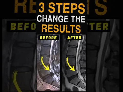 How to recover from Lumbar Disc Extrusion. 3 steps to follow #extrusión