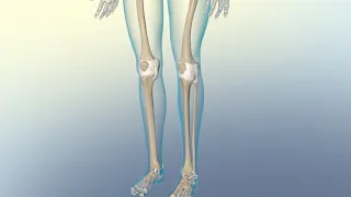 Understanding Osteoarthritis vs. Rheumatoid Arthritis
