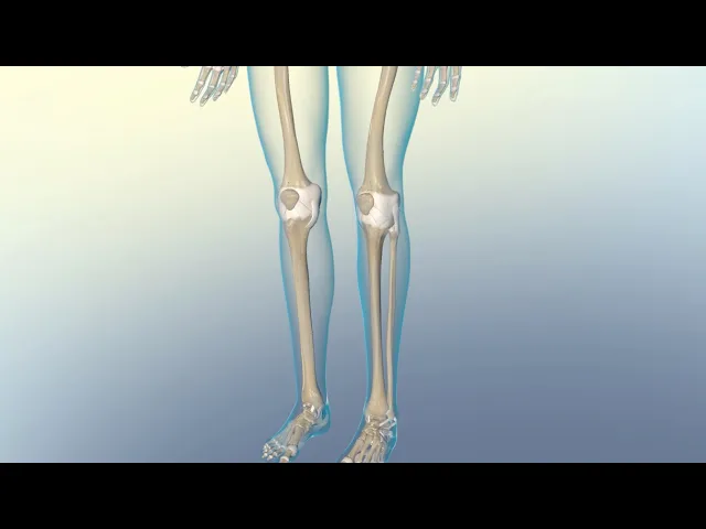 Video: Understanding Osteoarthritis vs. Rheumatoid Arthritis