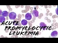 Acute Promyelocytic Leukemia APL microgranular vs classic cottage loaf cells Hematology