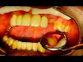How to Make a Quick Provisional Temporary Restoration
