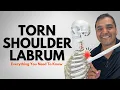 Torn Shoulder Labrum Everything You Need To Know Diagnosis Treatment