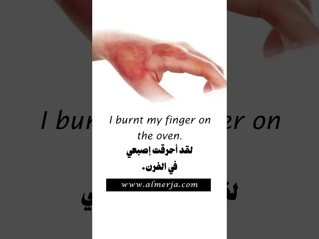 I burnt my finger on the oven.