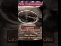 Download Lagu Fetal Hydrocephalus  with Spine normal #ultrasound #pregnancy  #congenital #hydrocephalus