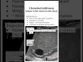 Choledocholithiasis stone in the common bile duct