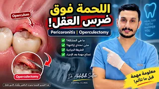 علاج التهاب اللثة حول ضرس العقل | Pericoronitis Treatment – Operculectomy #dr_abdullah_sultan