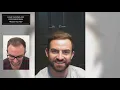 Hair Transplant International Alex Brown s Testimonial