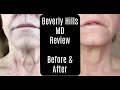 Beverly Hills MD Dermal Repair Complex Lift and Firm Sculpting Cream Before and After Anti-Aging