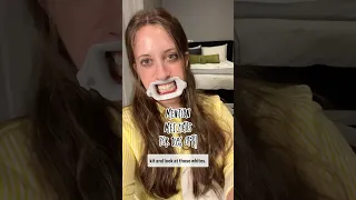 teethwhiteningbynechama this was the smoothest and easiest process Mention Metziahs for 10 Off