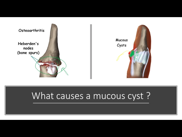 Mucous Cyst Diagnosis and Treatment by Dr. Anzarut