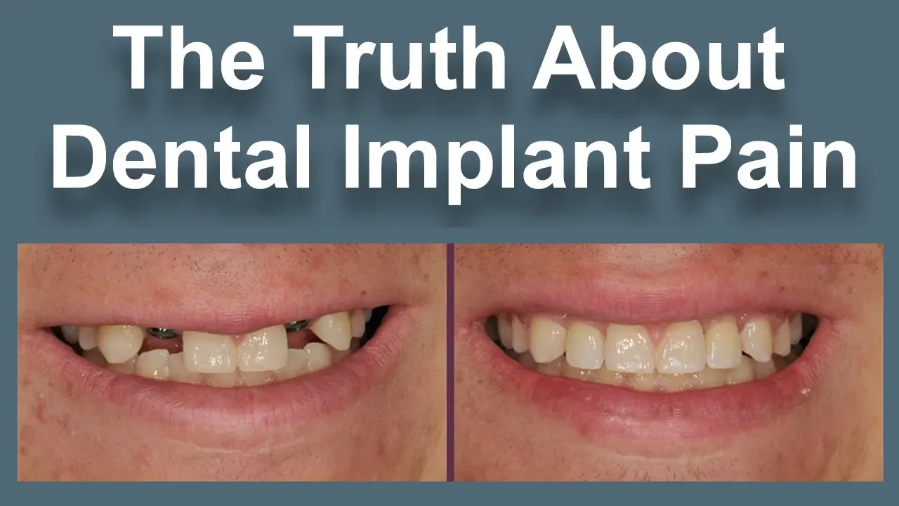Outline Video Are Dental Implants Painful?