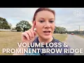 Prominent Brow Ridge How Ozempic Makes It Look Worse