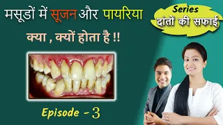 pyria ke lakshan gingivitis vs periodontitis symptoms pyria kya hai episode 3