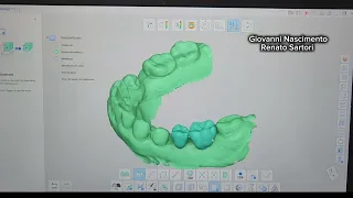 Guia de perfuração para implante - Cirurgia semi guiada