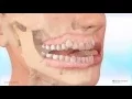 Download Carriere® Motion™ Appliance for Class III Correction - Patient Education Animation mp4 3gp mp3 videos - waplic