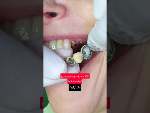 ازالة جسر قديم وتلبيس وزرع اسنان زيركونيا
