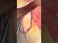 Download Lagu Laser Closure of Fistula Tract (FiLaC)   Video credit: SurgMedia (Youtube.com)