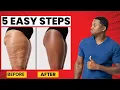 Cellulite Solutions Big Pharma Doesn t Want You To Know About