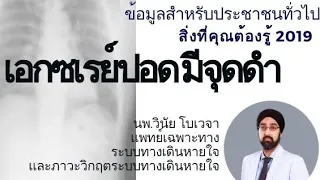 ก้อนหรือจุดในปอดที่พบจากการตรวจสุขภาพประจำปี แพทย์จะประเมินความเสี่ยงว่าเป็นมะเร็งได้อย่างไร
