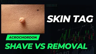 Skin Tag Acrochordon Difference between Shave biopsy Shave removal 11301 series