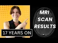 Download Lagu Multiple Sclerosis 17 Years On - MRI Scan Results