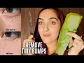 HOW TO REMOVE TINY BUMPS ON YOUR FACE They re NOT Acne MILIA