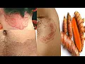 HOW TO GET RID OF RINGWORM JUST USING THIS 3 INGREDIENTS BEST WAY TO REMOVE A RINGWORM FAST