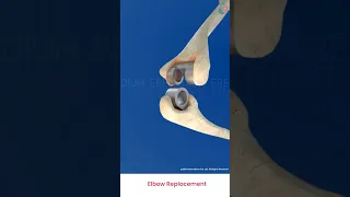 Total Elbow Replacement 3D Medical Animation