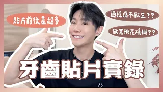 做完我後悔了嗎?半年後揭曉牙齒貼片心得|超完整 G-Smile 鋯白貼片全流程紀錄