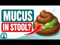 Mucus in Stool Causes Symptoms and Treatment