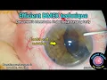 Download Lagu CataractCoach™ 2368: efficiënte DMEK-techniek voor hoornvliestransplantatie