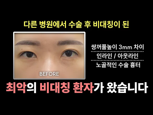 [실제성형리뷰] 쌍꺼풀 수술 후 비대칭이 된 환자를 쌍꺼풀 재수술로 치료한 과정