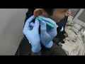 Jesse s Orbital Piercing