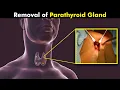 How Parathyroid Gland Surgery Is Performed