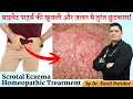 Instant relief from itching and burning in the private parts Scrotal Eczema Homeopathic Treatment