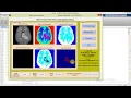 Matlab Project for Brain Tumor Detection Using Segmentation Final Year Project with Source Code