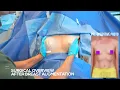 Late 30 Year Old Silicone Breast Augmentation Dr William Rahal Beverly Hills CA