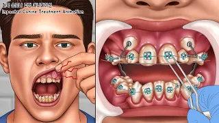 ASMR 잇몸 속에 숨어있는 송곳니 교정 | 치석 스케일링 | Impacted Canine Treatment | Tartar Removal & Teeth Scaling