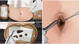 ASMR | Remove Huge Navel Stone Animation