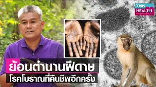 โรคฝีดาษในประเทศไทยมีประวัติการระบาดอย่างไรบ้าง