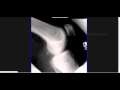 Interpreting X-Rays of the Knee Joint