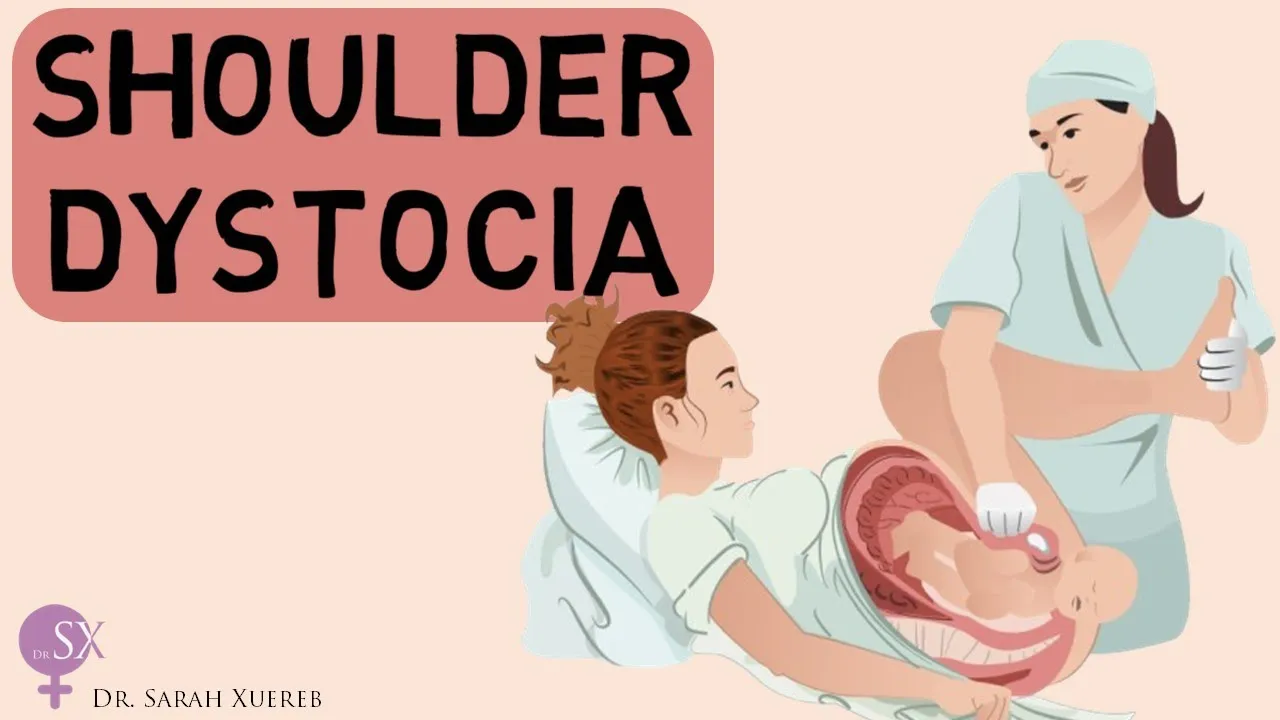 Shoulder Dystocia