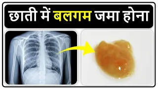 छाती में बलगम जमा होना | Heavy Cough and mucus in Chest |