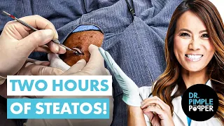 The Most SATISFYING Steatocystoma Session Ever