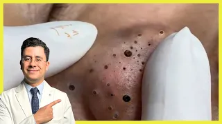 أسرع طريقة لازالة الرؤوس السوداء 